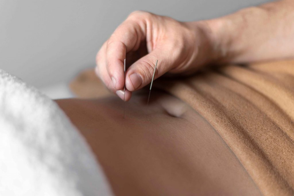What You Need to Know About Chinese Medicine Acupuncture